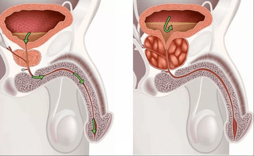Symptome einer Prostatitis
